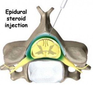 enjeksiyon boyun ağrısı