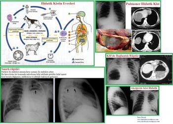 Kist hidatik (akciğer kisti) belirtileri, tanı ve tedavisi