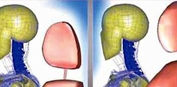 Trafik kazalarından sonra oluşan kamçı yaralanmasına dikkat!