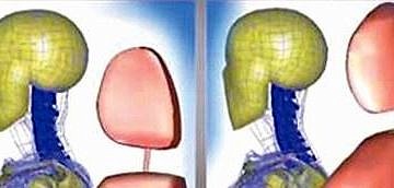 Trafik kazalarından sonra oluşan kamçı yaralanmasına dikkat!