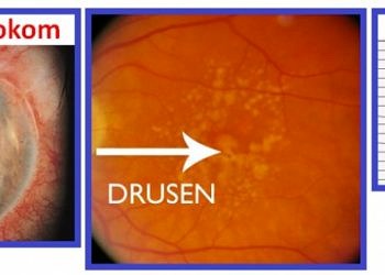Retina hastalıkları tanı ve tedavisi