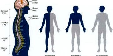 Hemipleji rehabilitasyonu