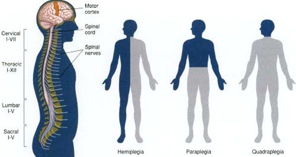 hemipleji-hemiplegia