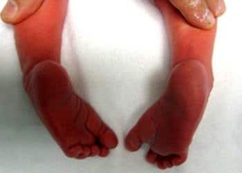 Doğuştan çarpık ayak (Pes Ekinovarus) ameliyatsız tedavi edilebiliyor!