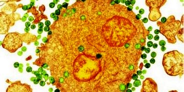 Gen terapisiyle HIV’e karşı uygulanan kalkan başarılı sonuç verdi