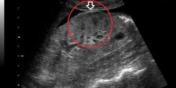 Böbrek tümörleri tanı ve tedavisi