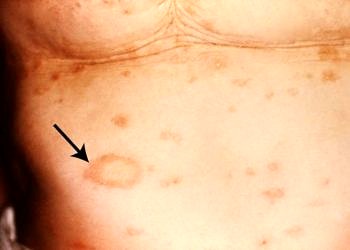 Bakteryel deri hastalıkları (Piyodermalar) tanı ve tedavisi