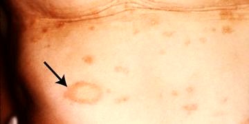 Bakteryel deri hastalıkları (Piyodermalar) tanı ve tedavisi