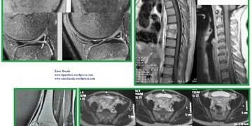 Yumuşak doku lezyonları tanı ve tedavisi
