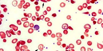 Talasemi (Akdeniz anemisi) tedavisi maliyetli, korunması ucuz bir hastalık!