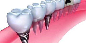 İmplantlar çene kemiğinizin erimesini engelliyor