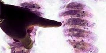 Akciğer kanserinde onkogeni hedef alan tedaviler sağkalımı uzatıyor