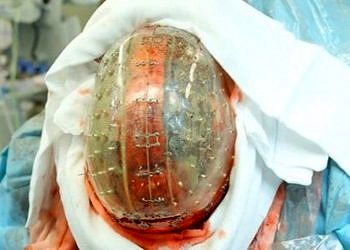 Nörocerrahlar 3 boyutlu yazıcıyla üretilen kafatasını başarıyla insana yerleştirdi!