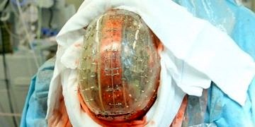 Nörocerrahlar 3 boyutlu yazıcıyla üretilen kafatasını başarıyla insana yerleştirdi!