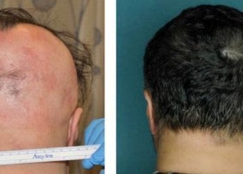 Kemik iliği ilacıyla saçkıran tedavisi