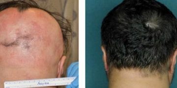 Kemik iliği ilacıyla saçkıran tedavisi