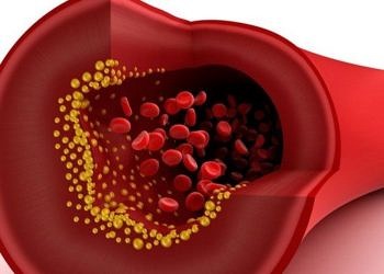 En sık görülen ölüm nedeni: damar sertliği