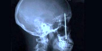 Bugüne kadar insan vücudundan ameliyatla çıkarılmış 15 garip nesne!