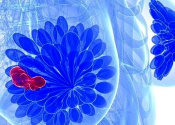 D Vitamini takviyesi meme kanseri tedavisinde sağ-kalımı arttırıyor!