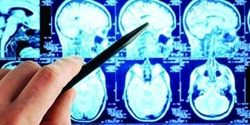 Anti-psikotik ilaçlar beyin kanseri tedavisinde umut olabilir mi?