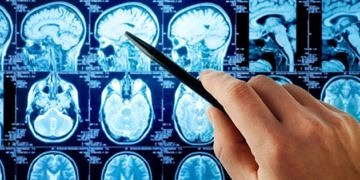 Görme ve konuşma bozuklukları beyin tümörü belirtisi olabilir
