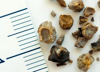 Böbrek taşi tedavisinde yeni bir teknoloji: Endoskopik lazer cerrahisi