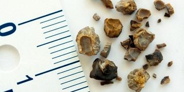 Böbrek taşi tedavisinde yeni bir teknoloji: Endoskopik lazer cerrahisi