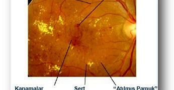 Diyabetik makuler ödem (DMÖ) nedir?