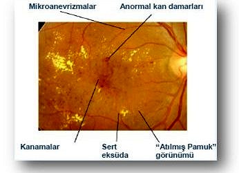 Diyabetik makuler ödem (DMÖ) nedir?