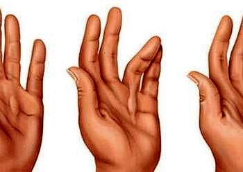 El ve bilekteki romatizmal rahatsızlıklar ve eklem ağrılarının tedavisi