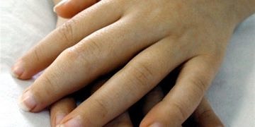 Çocuklarda jüvenil romatoid artrit tanı ve tedavisi