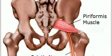 Piriformis sendromu nedir? Neden olur? Belirtileri ve tedavisi
