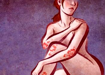 Sedef hastaları başka pek çok ciddi hastalık riski de taşıyorlar