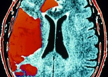 İyi eğitimli kişilerde unutkanlık, felç habercisi