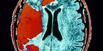 İyi eğitimli kişilerde unutkanlık, felç habercisi