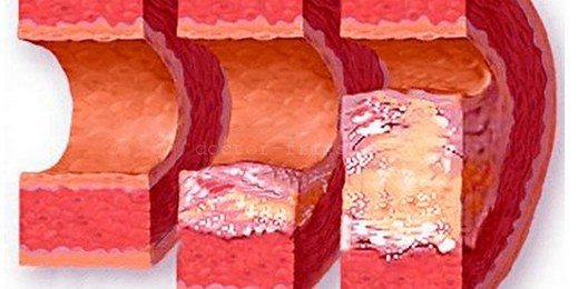 ateroskleroz-nedir,belirtileri-tedavisi