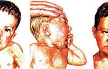 Bebeklerde boyun eğriliğini