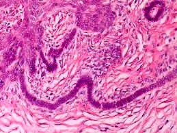 Bazal hücreli karsinom tanı ve tedavisi