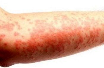 Egzama (atopik dermatit) neden olur? Belirtileri ve tedavisi
