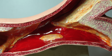 Kolesterol nedir? Neden yükselir? Tedavisi ve iyi gelen yiyecekler