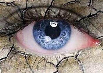 Kuru göz hastalığı ciddi bir halk sağlığı sorunu olmaya devam ediyor!