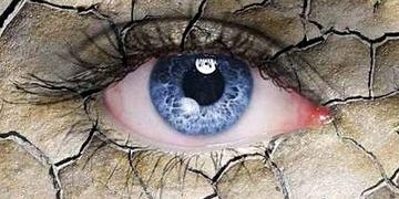 Kuru göz hastalığı ciddi bir halk sağlığı sorunu olmaya devam ediyor!