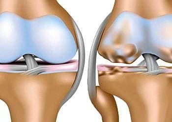 Hücredeki çinko düzeyi, osteoartrit tedavisindeki eksik halka mı?