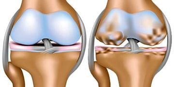 Hücredeki çinko düzeyi, osteoartrit tedavisindeki eksik halka mı?