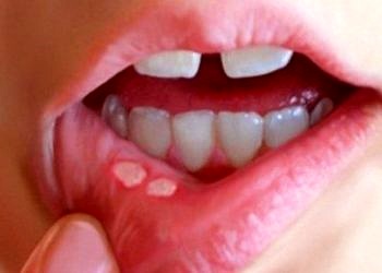 Tekrarlayan ağız yaraları bağışıklığı tehdit ediyor