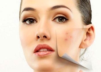 Akne nedir? Sivilcenin nedenleri, çözümü ve pratik öneriler