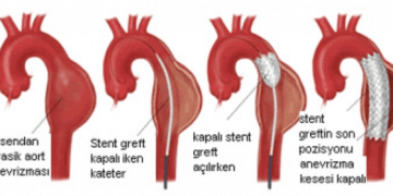 İntratorasik aort anevrizması ve diseksiyonları