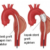 İntratorasik aort anevrizması ve diseksiyonları