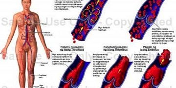 Derin ven trombozu tanı ve tedavisi