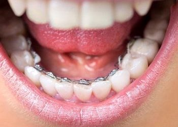 Görünmeyen diş teli uygulaması yaygınlaşıyor